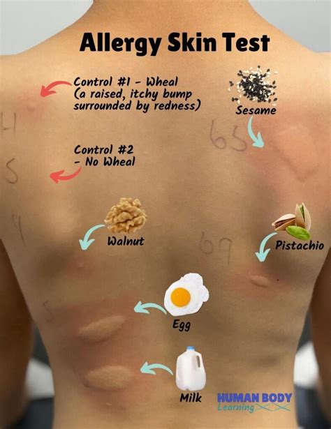 food allergy test ph|How To Read Allergy Skin Tests: All You Need To Know.